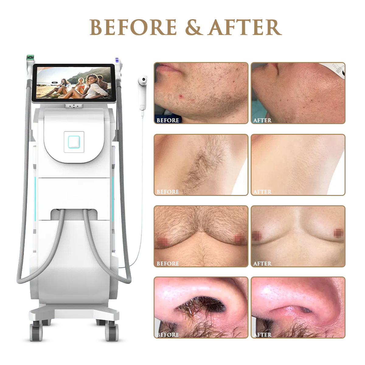 Skin Monarch Qantum Pro Diode & Picosecond Laser